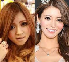 一条響の整形前後の顔の変化がヤバい!豊胸や整形外科クリニックについてもまとめてみた ダウンロード 6 - 一条響の整形前後の顔の変化がヤバい!豊胸や整形外科クリニックについてもまとめてみた